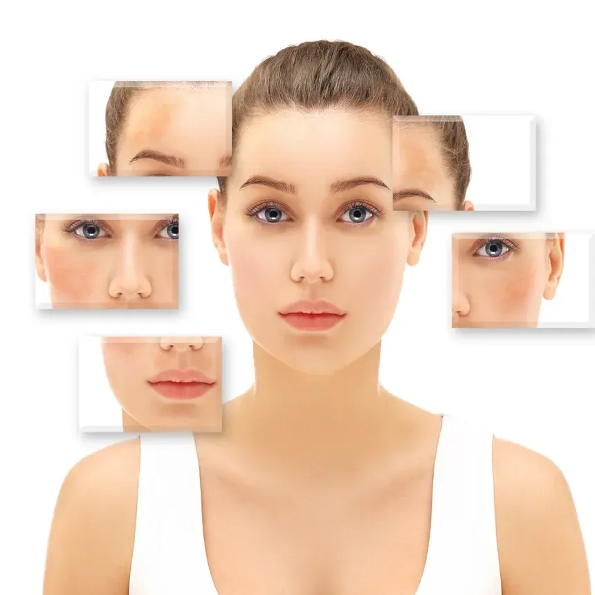 O impacto do estresse na formação e agravamento do melasma facial O impacto do estresse na formação e agravamento do melasma facial