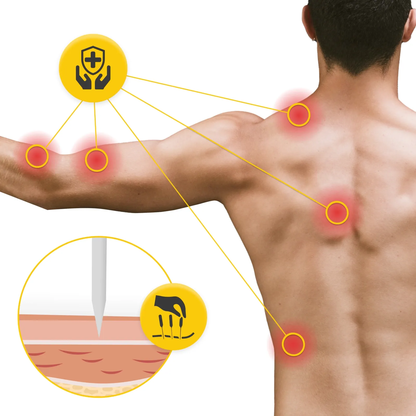Akupunktūros adatos su kreiptuvu